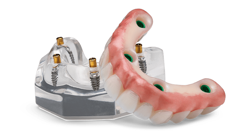 IMPLANT-SUPPORTED-DENTURES