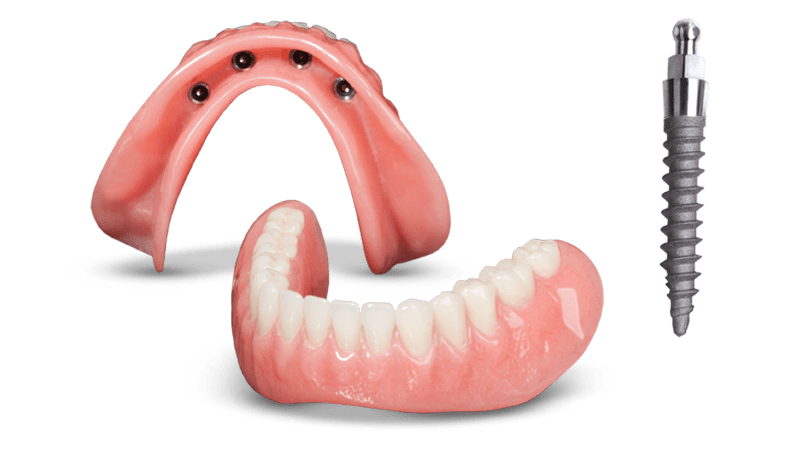 IMPLANT-SUPPORTED-OVERDENTURE
