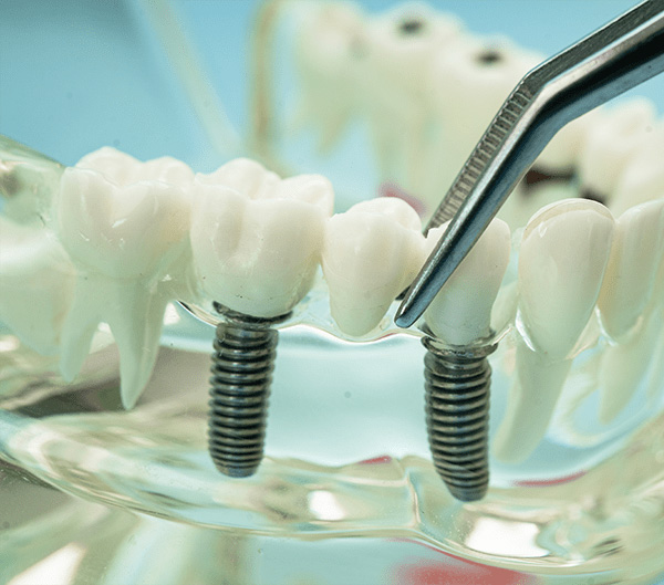 Dental Implants in Fort St. John