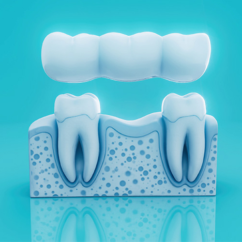 Dental Bridges in Fort St. John — Greenwoods Dental Centre ✅