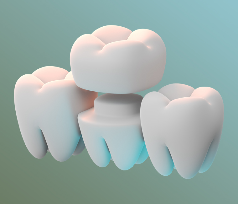 types of dental crowns at greenwoods fsj