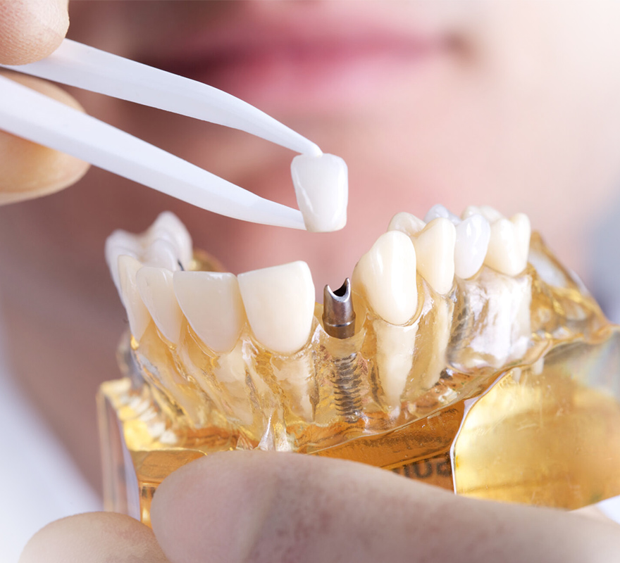 Dental Implants in Fort St. John | Greenwoods Dental Centre