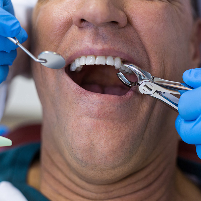 tooth removal in fort st. john tooth removal in fort st. john