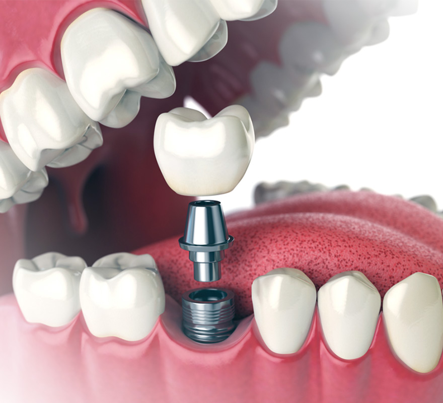 dental implants in fort st. john